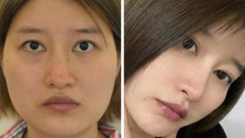 鼻部手术局麻与全麻：哪种更适合你？**