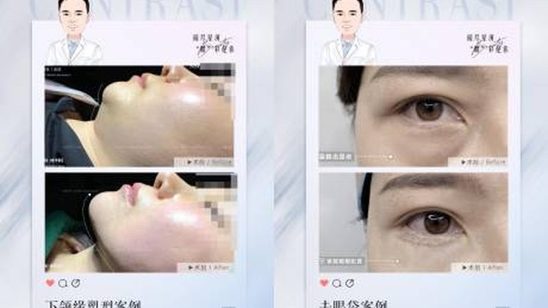 北京隆鼻与微整恢复对比：揭秘术后真实变化