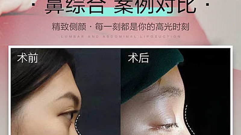 硅胶隆鼻术后，这些注意事项你了解吗？**