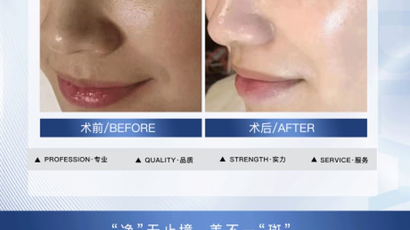 激光美容仪器，如何挑选优质直销产品？**
