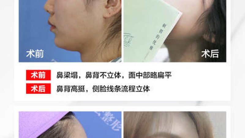 北京隆鼻医院排名及价格