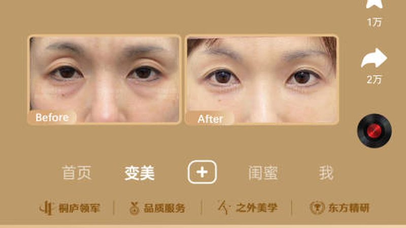激光治疗黄褐斑，揭秘淡化次数的真相